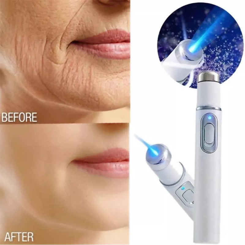 Lapiz Laser Azul Anti Hongos y Acne Import !